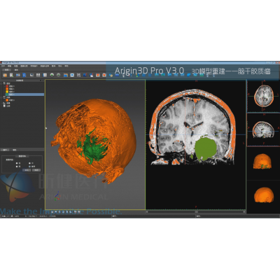 基于Arigin3D Pro V3.0的脑干胶质瘤3D模型重建